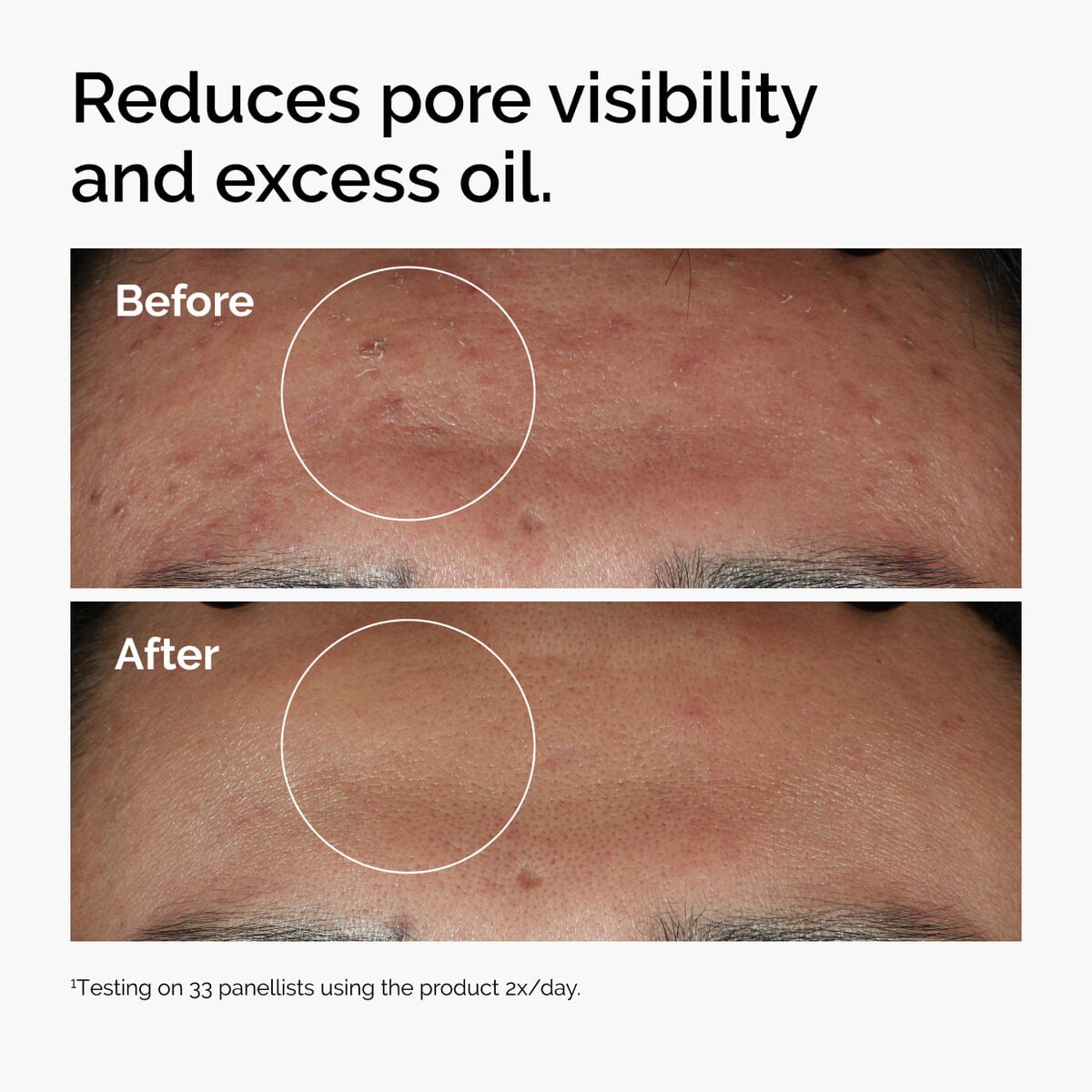 niacinamide-10-zinc-1-a2 ord-niacinamide-zinc-blemish-serum-before-after-pores.jpg