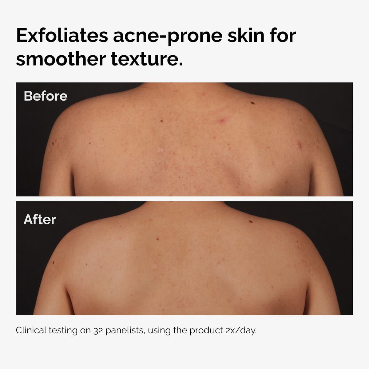 salicylic-acid-0-5-body-serum-q6 ord-salicylic-acid-body-serum-before-after-graphic-NA.jpg