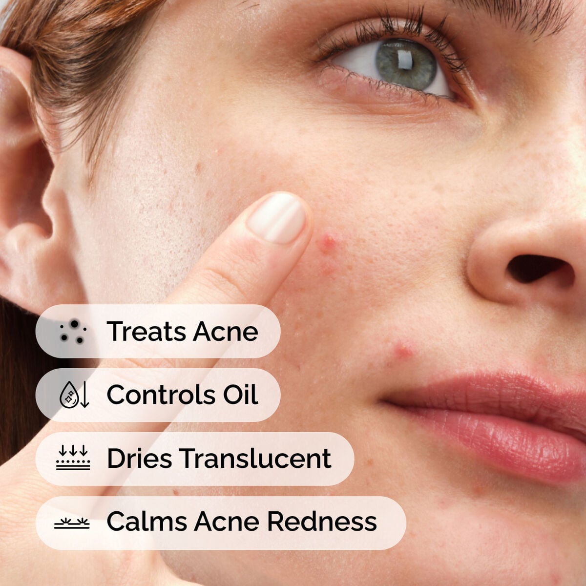 sulfur-10-powder-to-cream-concentrate-j3 ord-sulfur-10pct-powder-to-cream-concentrate-model-application-with-benefits-acne.jpg