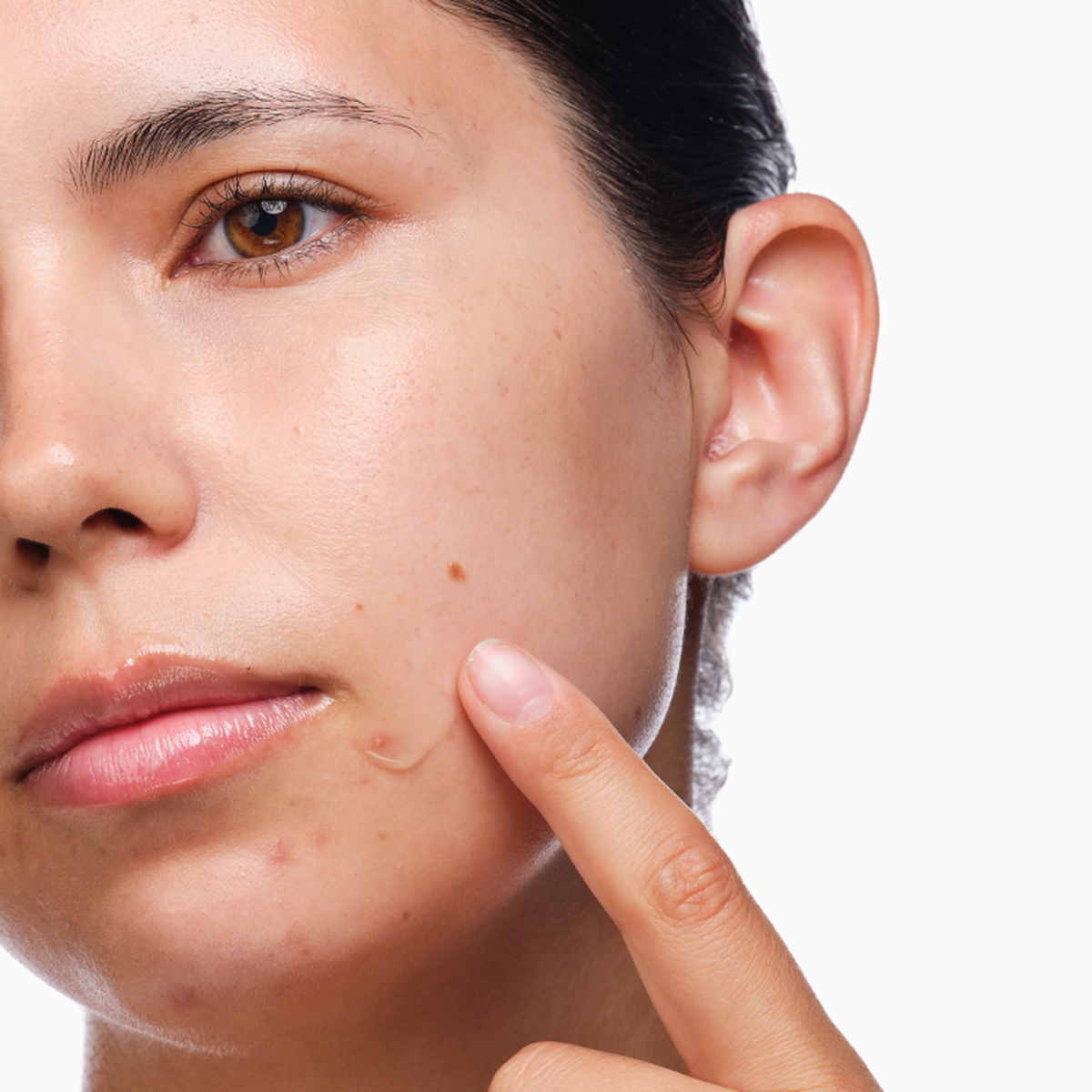 the-acne-set-q9 rdn-the-acne-set-application.png